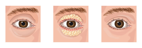 Blepharoplasty